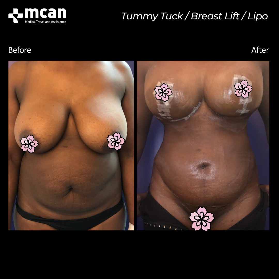 breast lift liposuction tummy tuck in turkey turkey before after 12042101