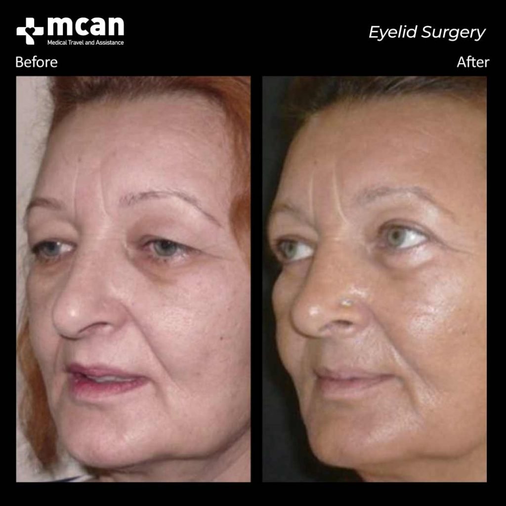 eyelid surgery before after 12042101