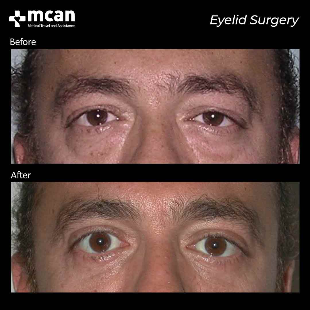 eyelid surgery before after 12042102