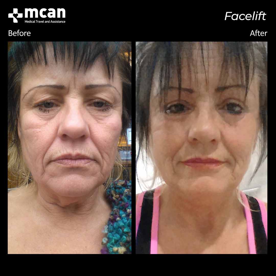 facelift turkey before after 12042101
