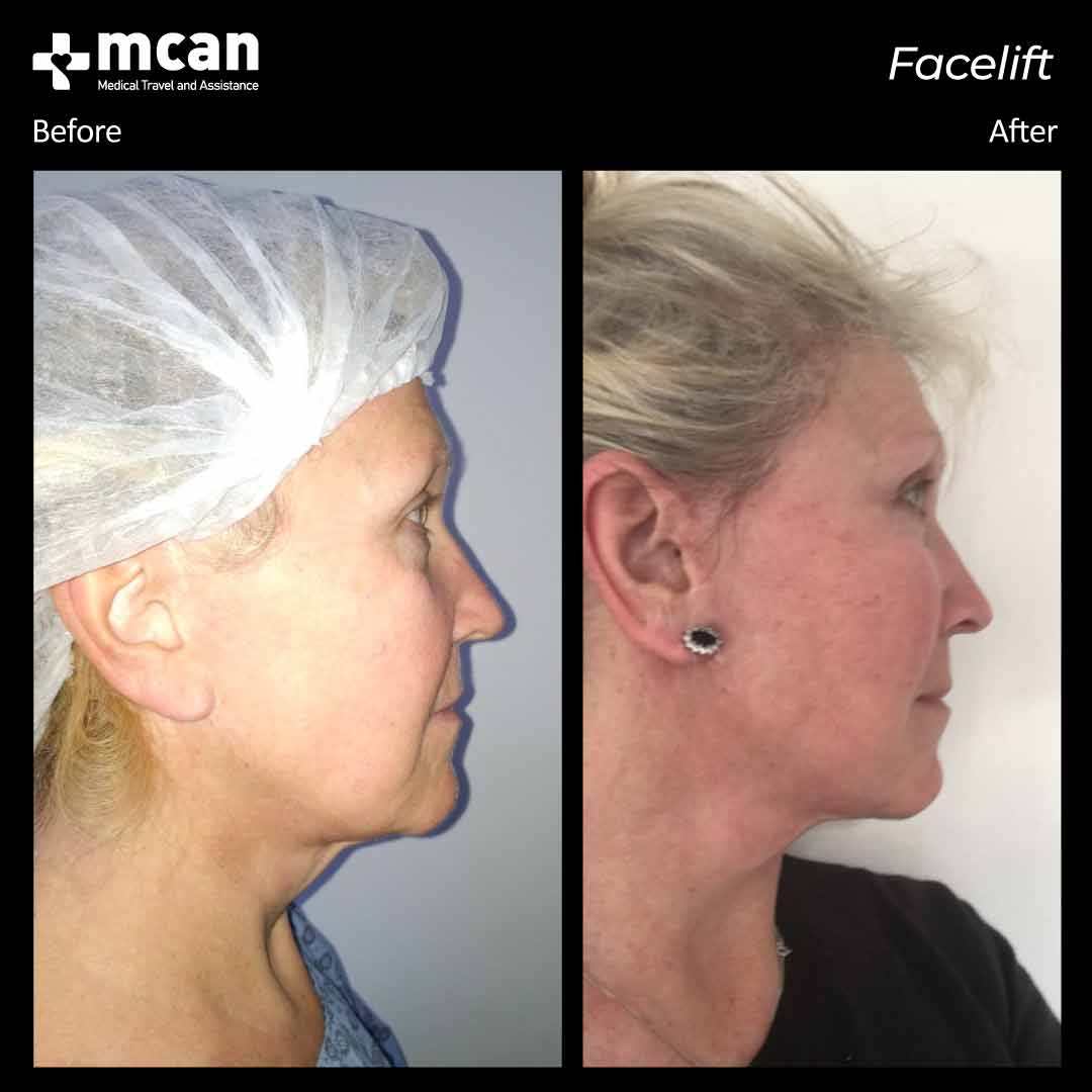 facelift turkey before after 12042102
