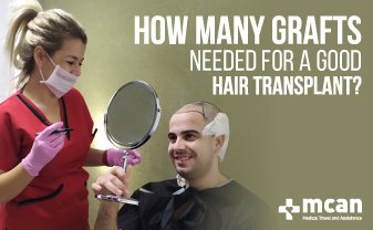 how many graft needed for hair transplant mcan health