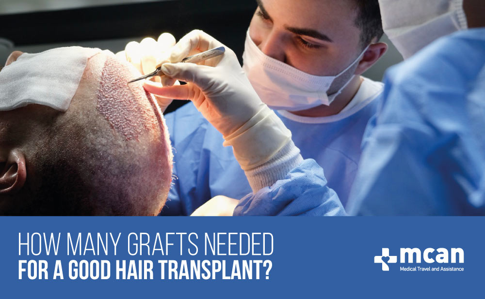 how many grafts do I need for hair transplant