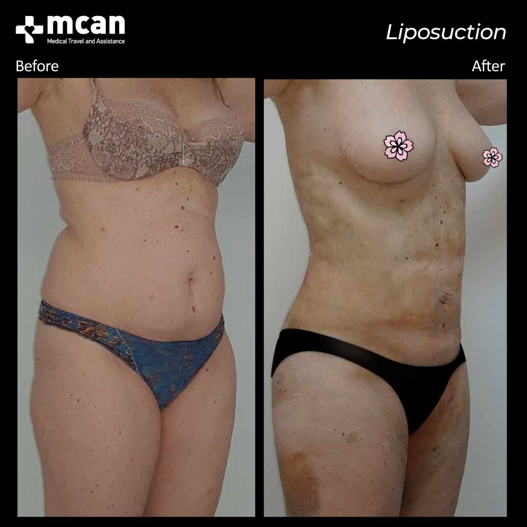 liposuction turkey before after 12042101