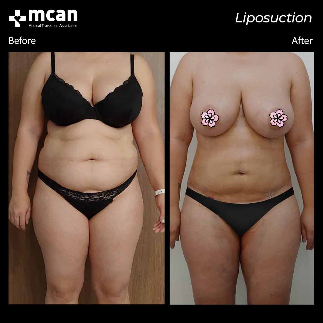 liposuction turkey before after 120421010