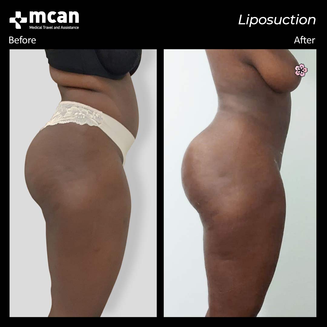 liposuction turkey before after 120421011