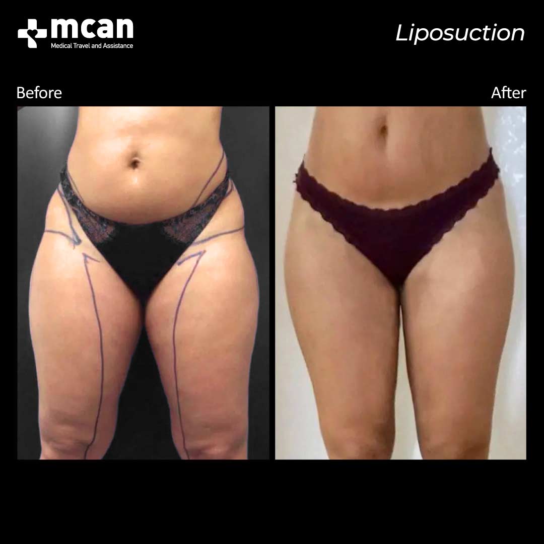 liposuction turkey before after 120421012