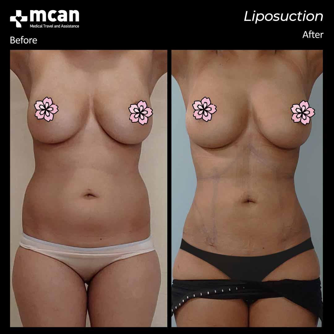 liposuction turkey before after 12042102