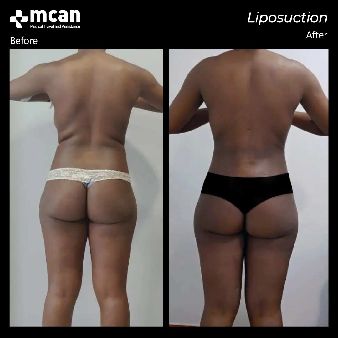 liposuction turkey before after 12042103
