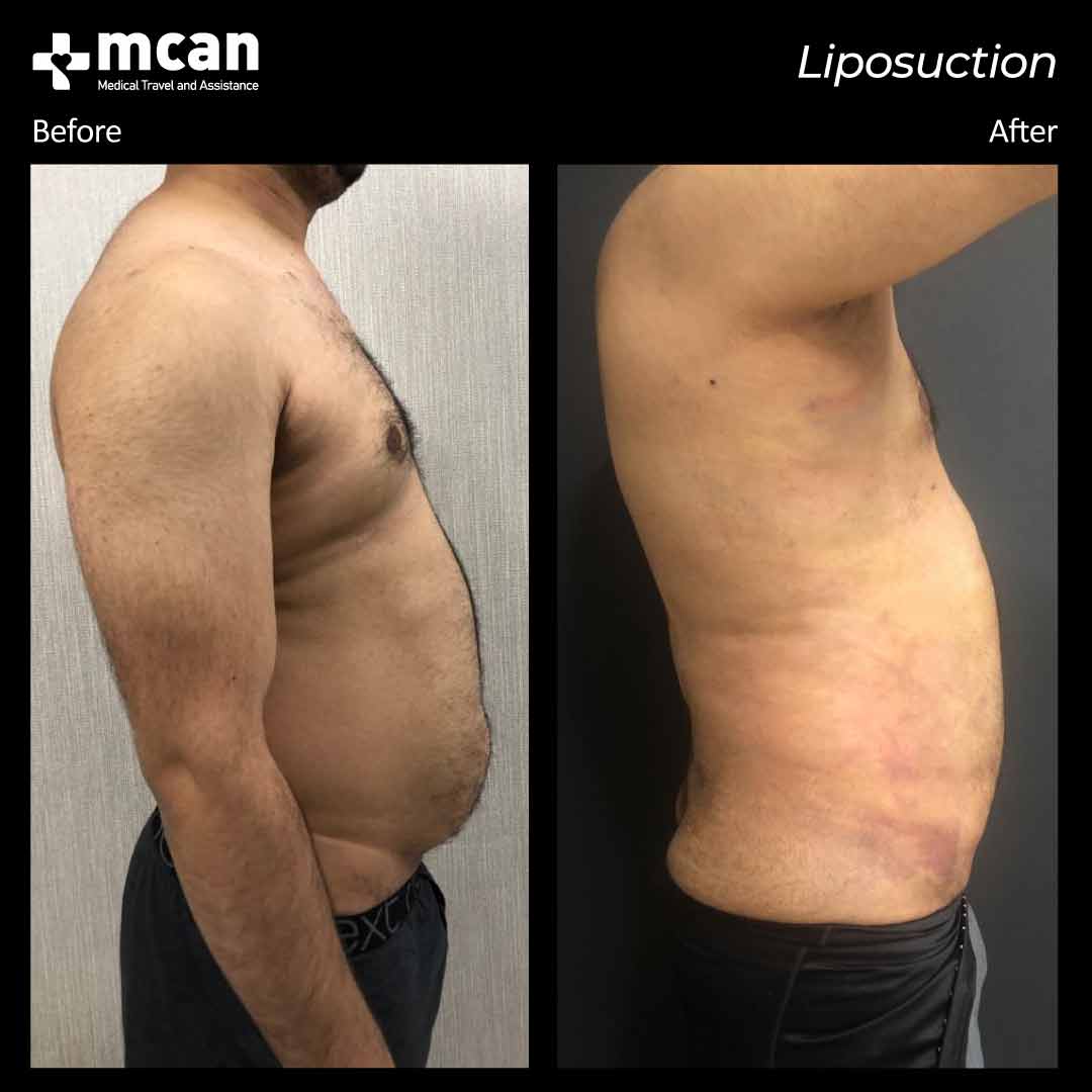 liposuction turkey before after 12042104
