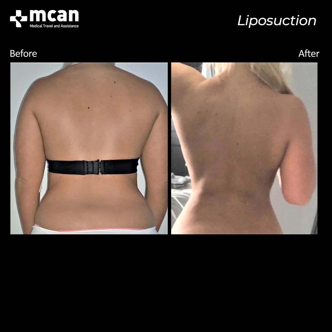liposuction turkey before after 12042107