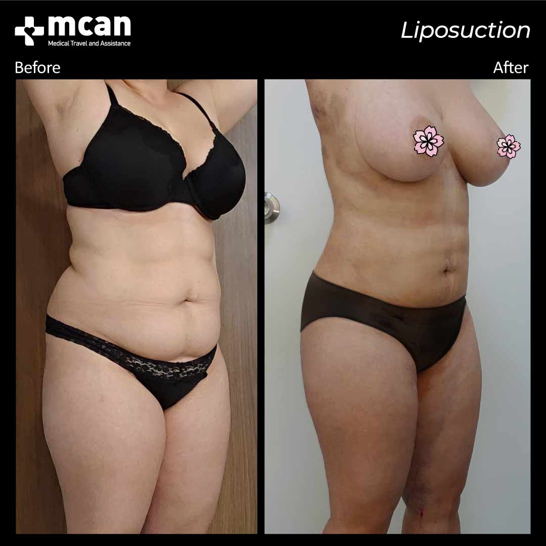 liposuction turkey before after 12042109