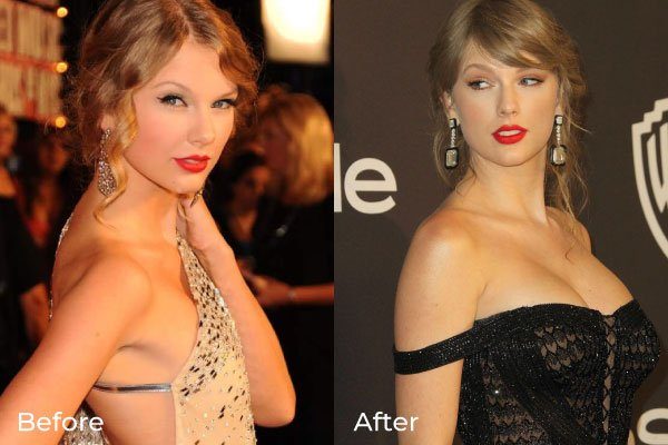 Taylor Swift Brustimplantate vorher und nachher