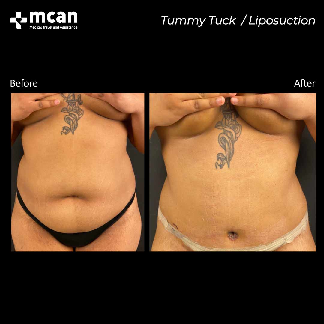tummy tuck liposuction in turkey before after 30042101