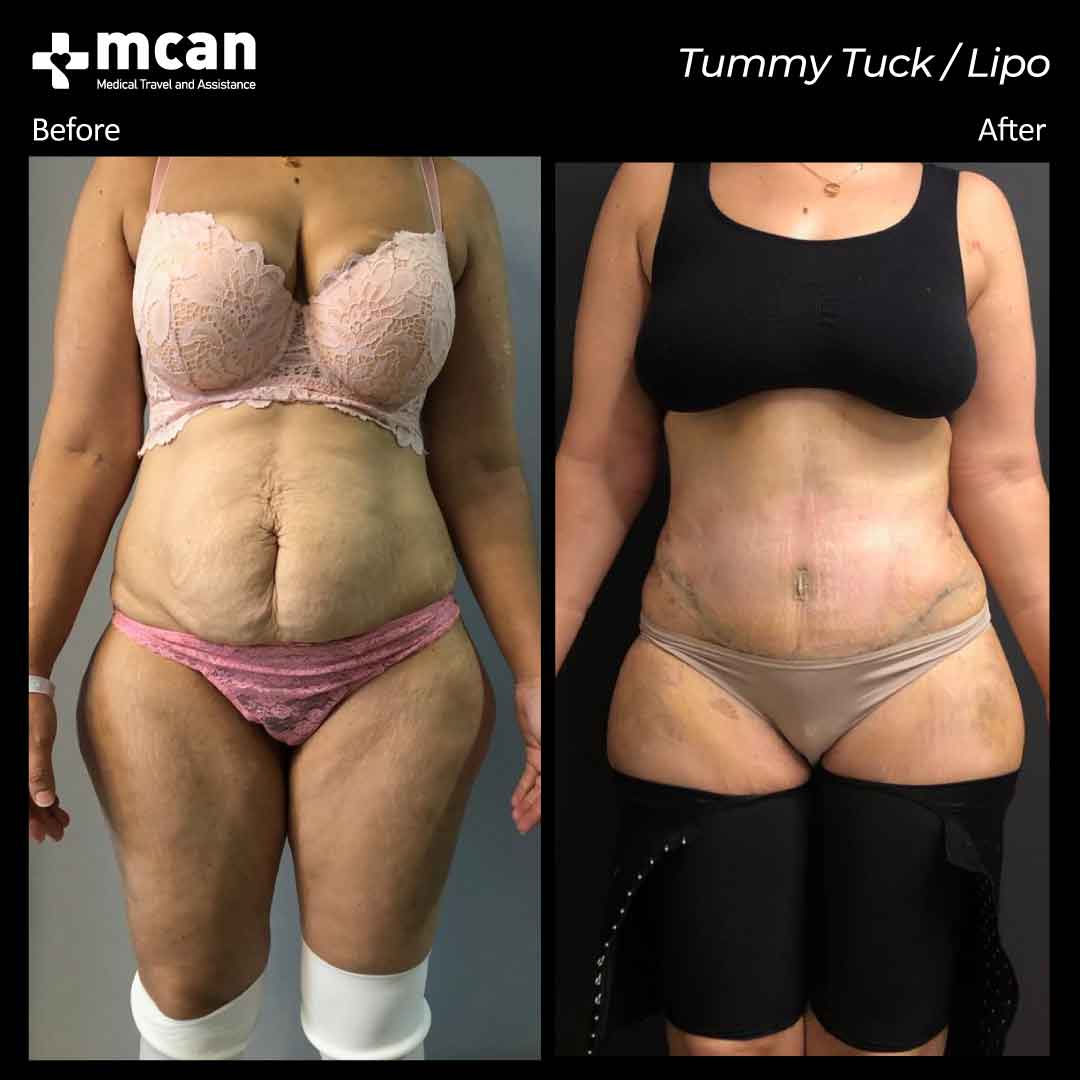tummy tuck liposuction turkey before after 12042101