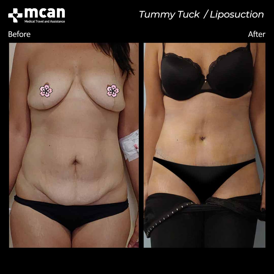 tummy tuck liposuction turkey before after 12042102