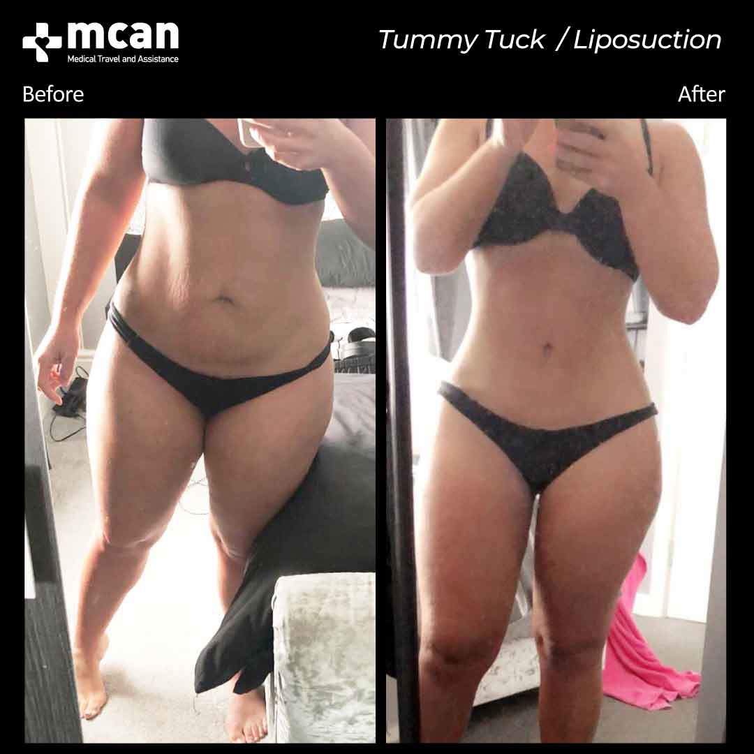 tummy tuck liposuction turkey before after 12042103