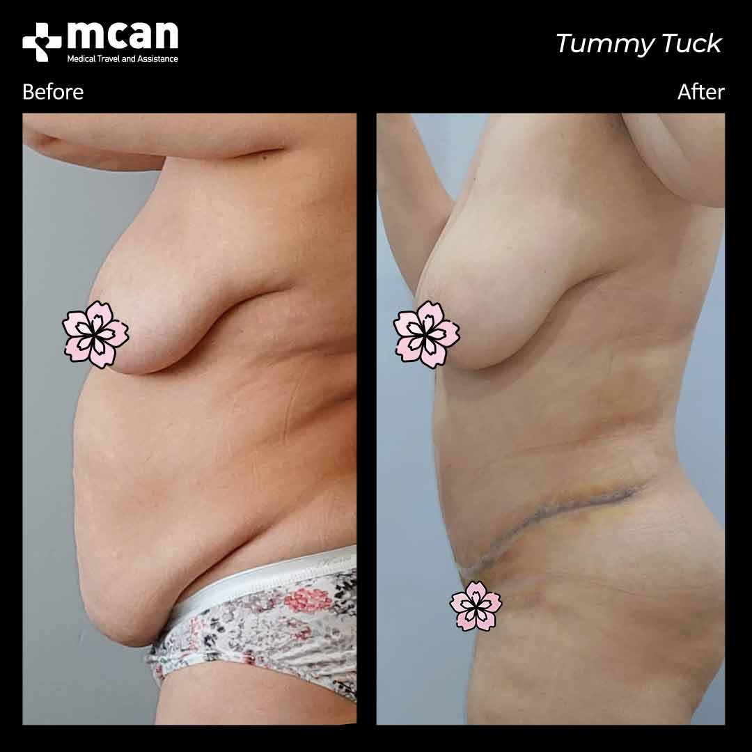 tummy tuck turkey before after 12042101