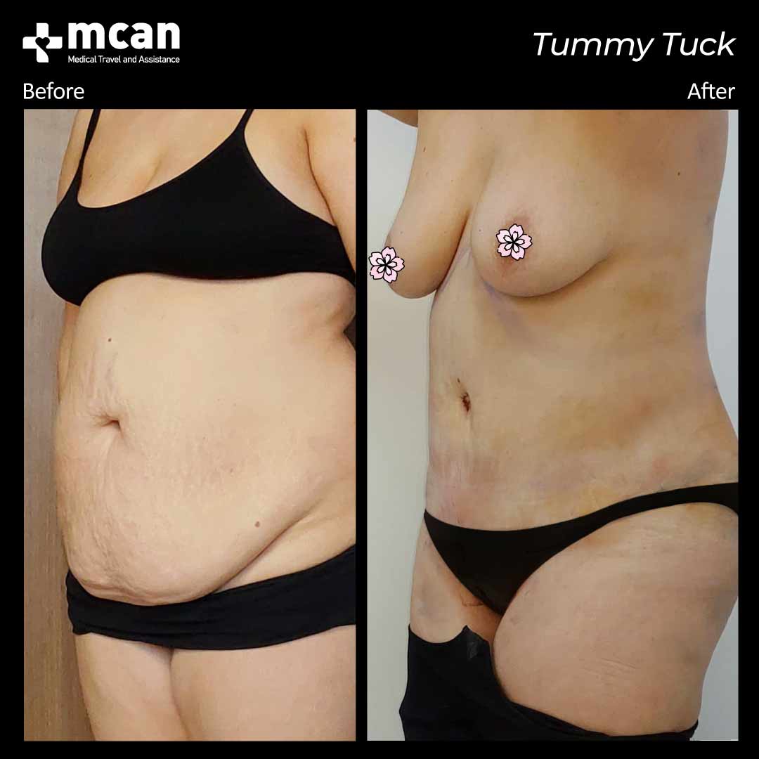 tummy tuck turkey before after 12042102