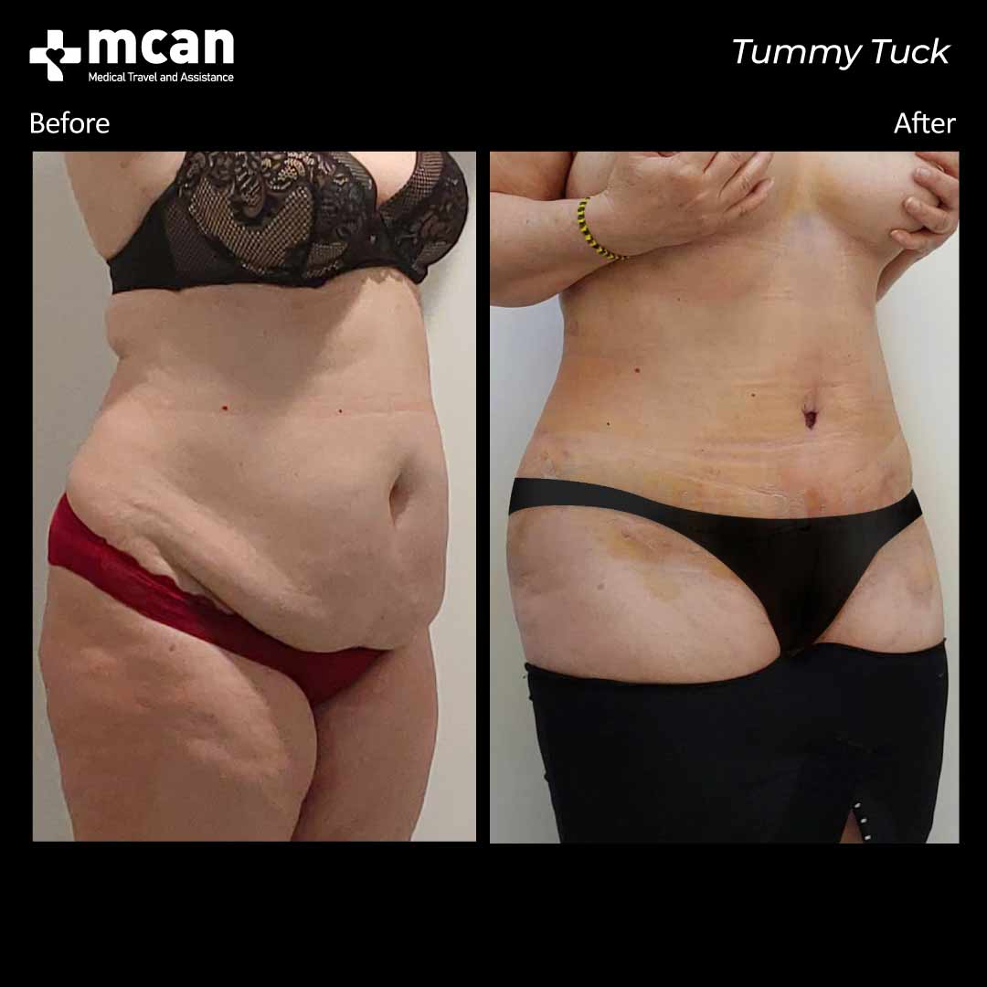 tummy tuck turkey before after 12042103