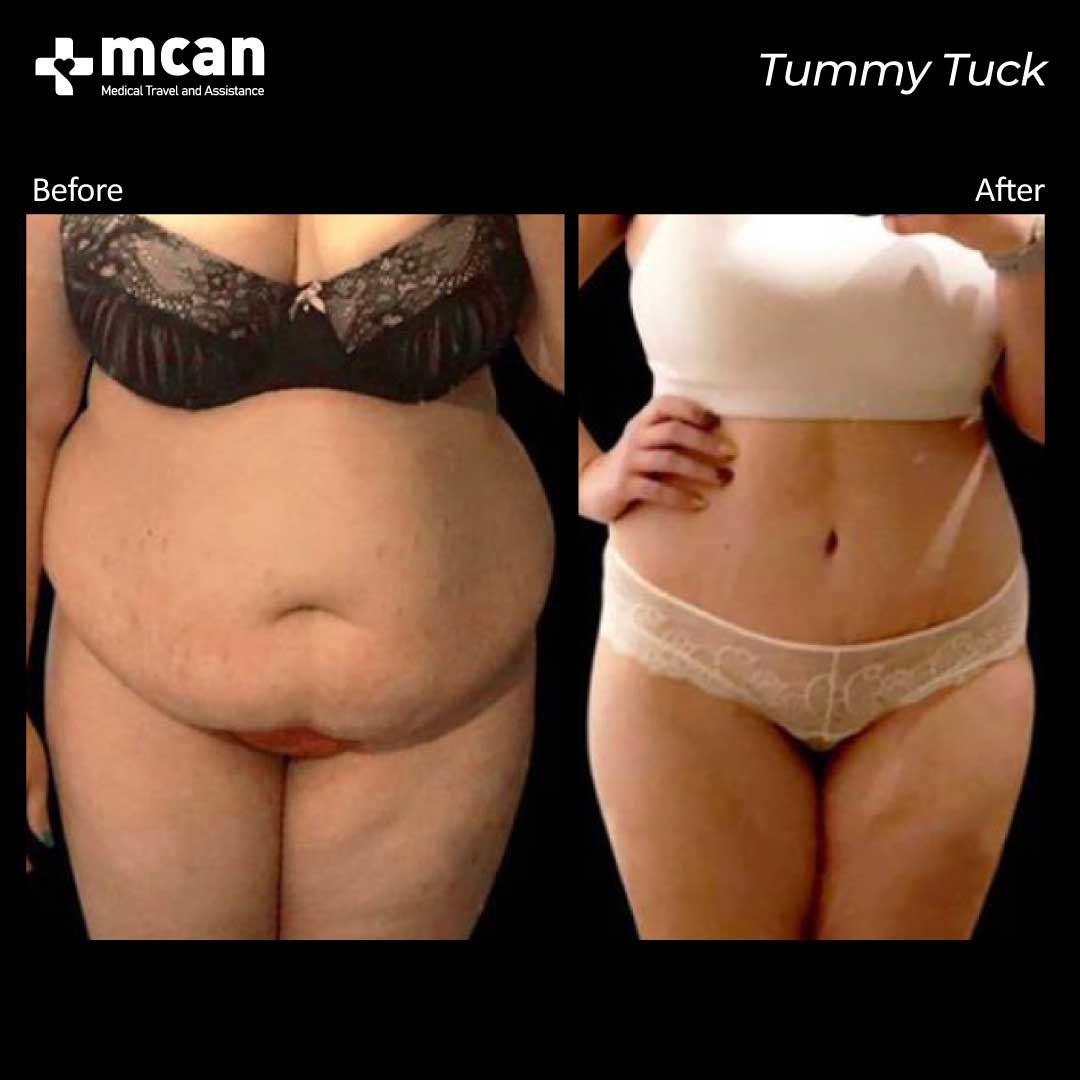 tummy tuck turkey before after 12042104