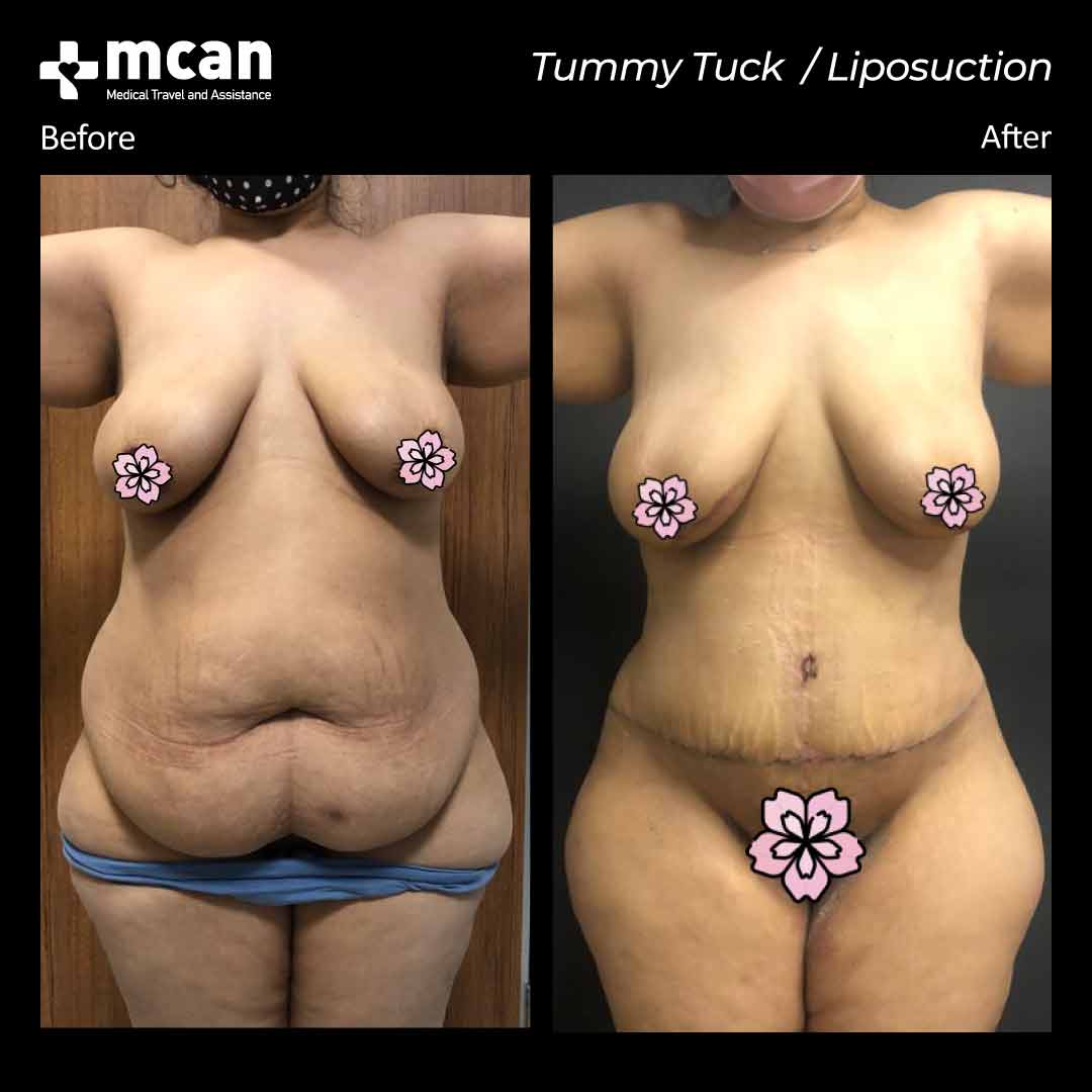 tummy tuck turkey liposuction turkey 080401