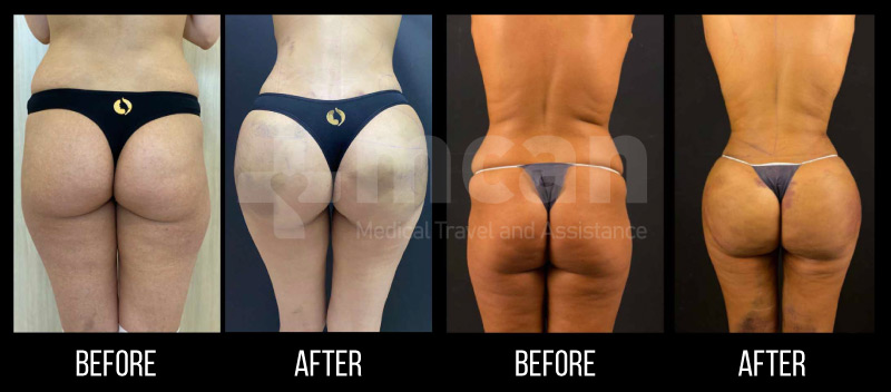 How Long Does a Brazilian Butt Lift Last? - Is It Permanent?