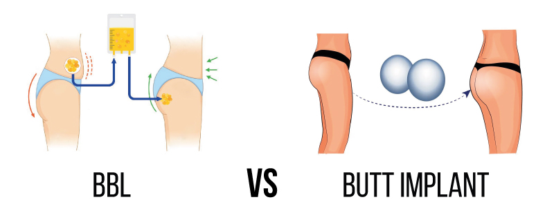 infographic of bbl vs butt implants 