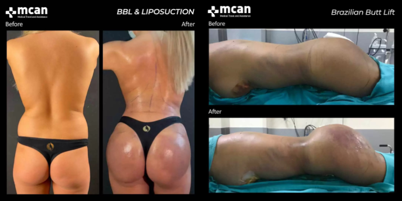 BBl before and after in MCAN health Turkey