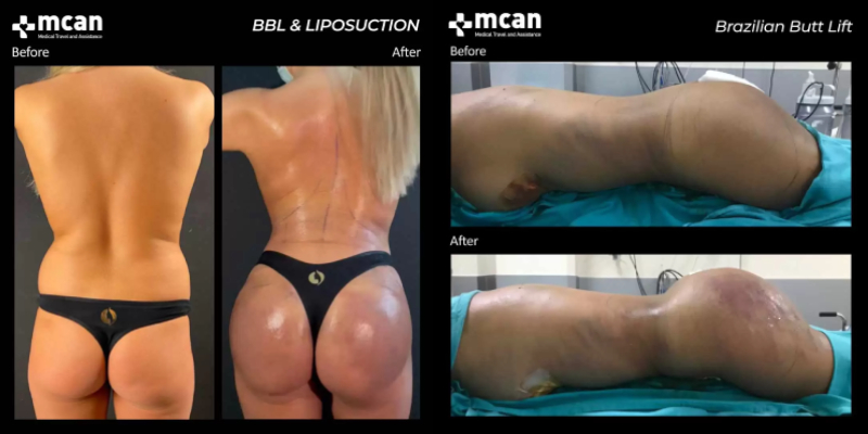 Brazilian Butt Lift Surgery, Madison & Milwaukee