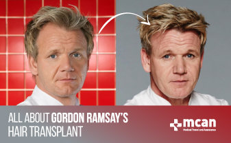 All About Gordon Ramsay’s Hair Transplant