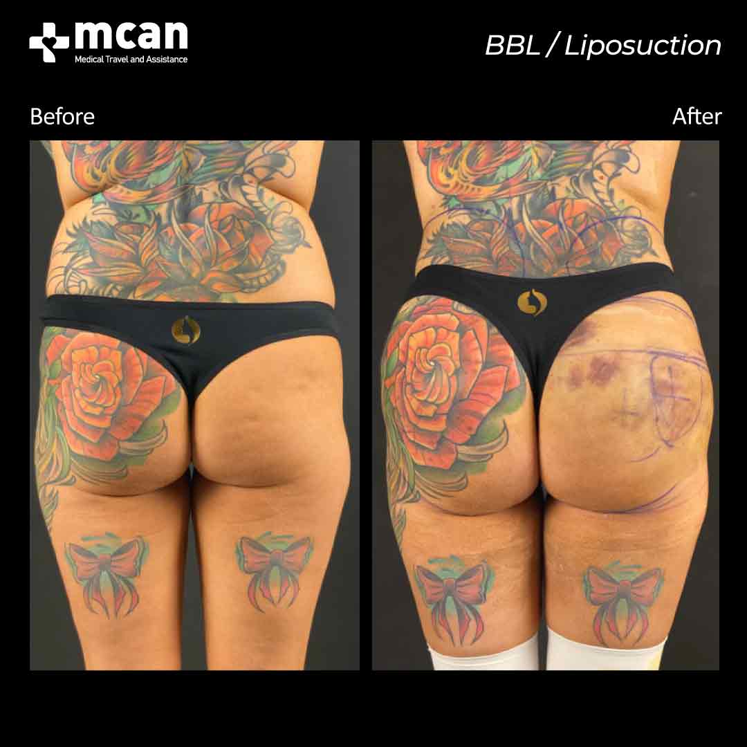 bbl and liposuction turkey before after 07052103