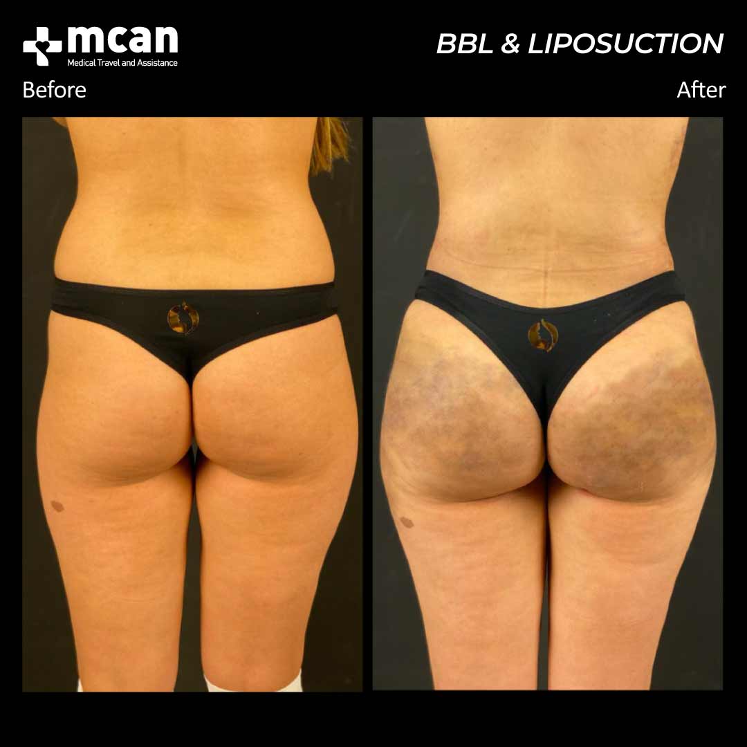 bbl liposuction in turkey before after 200501