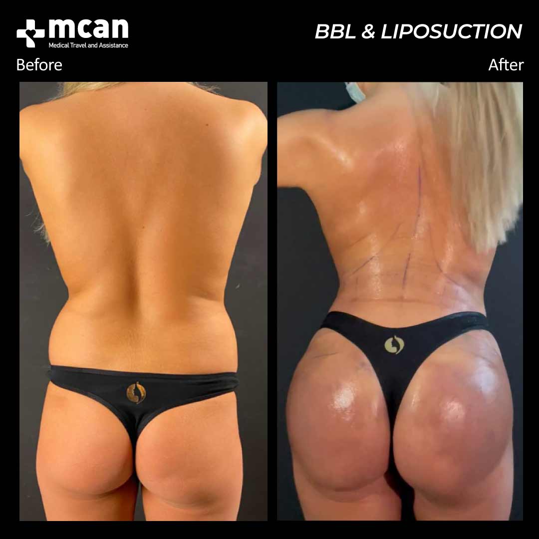 bbl liposuction in turkey before after 200502