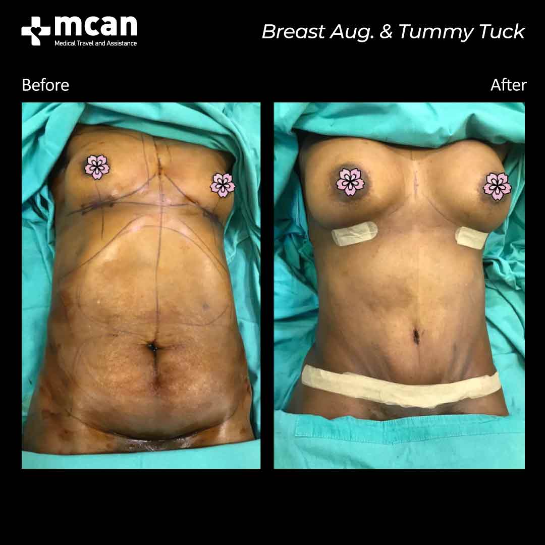 breast augmentation tummy tuck turkey before after 07052101