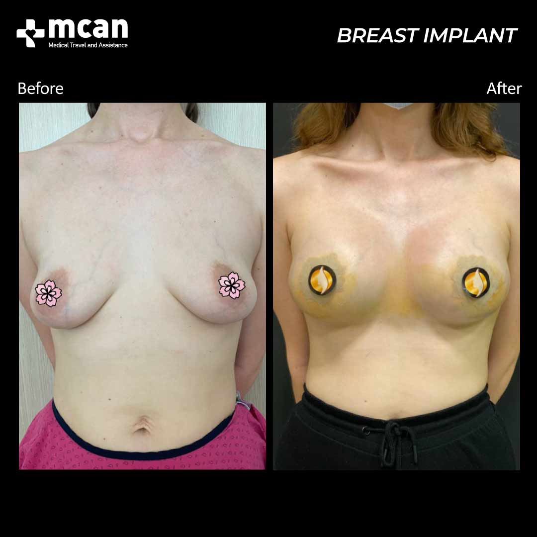 breast implant turkey before after 200501