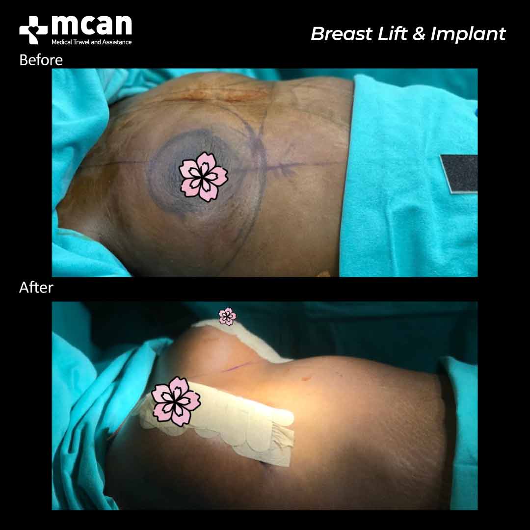 breast lift implant in turkey before after 200503