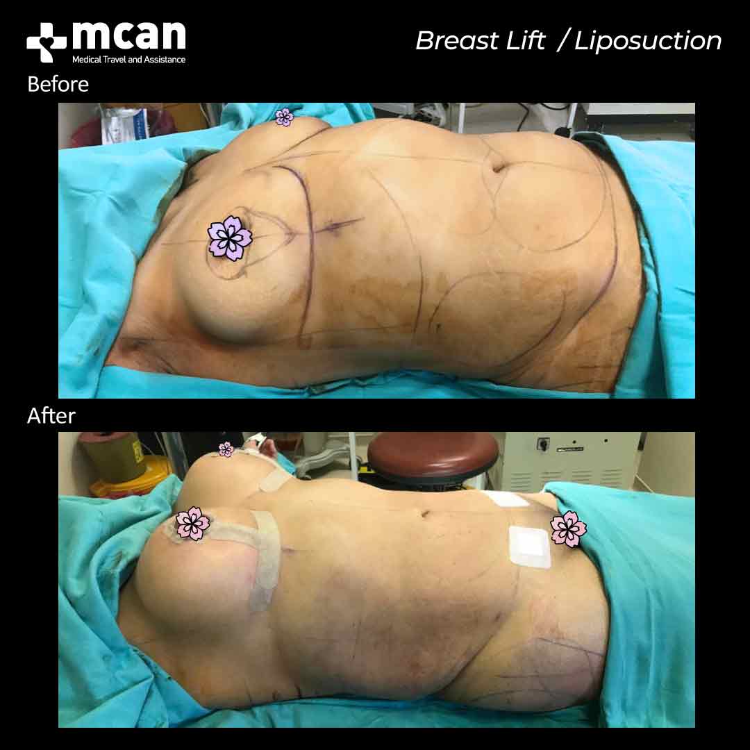 breast lift liposuction turkey before after 07052101