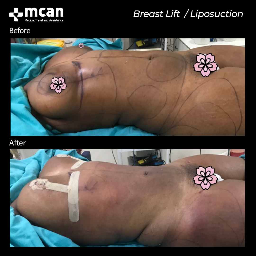 breast lift liposuction turkey before after 07052102
