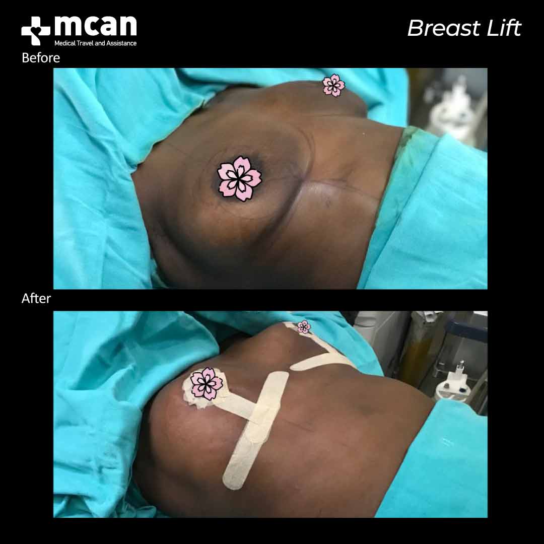 breast lift turkey before after 07052101