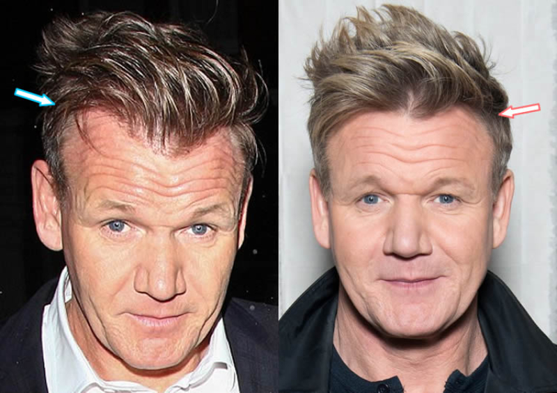 Gordon Ramsey before and after hair transplant