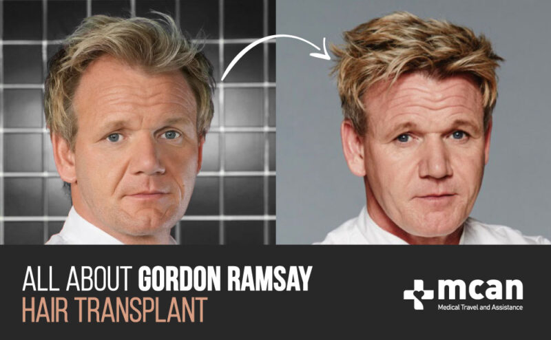 Gordon Ramsay Hair Transplant Before and After