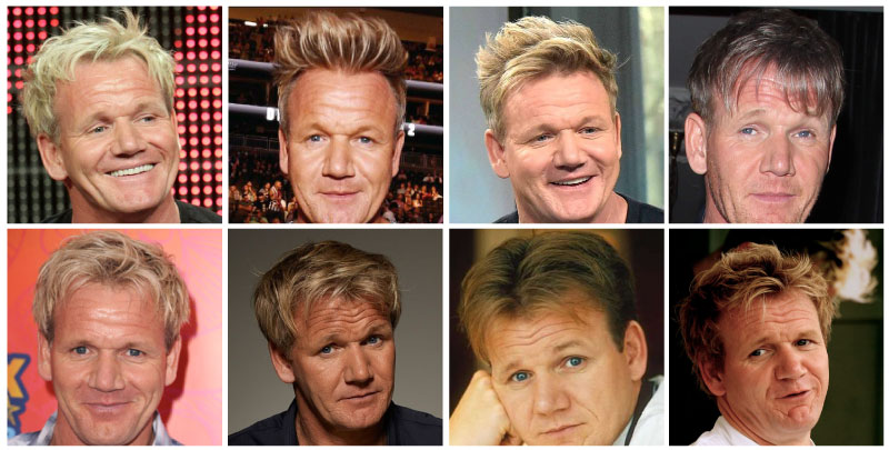 Gordon Ramsay Hair Transplant Before and After