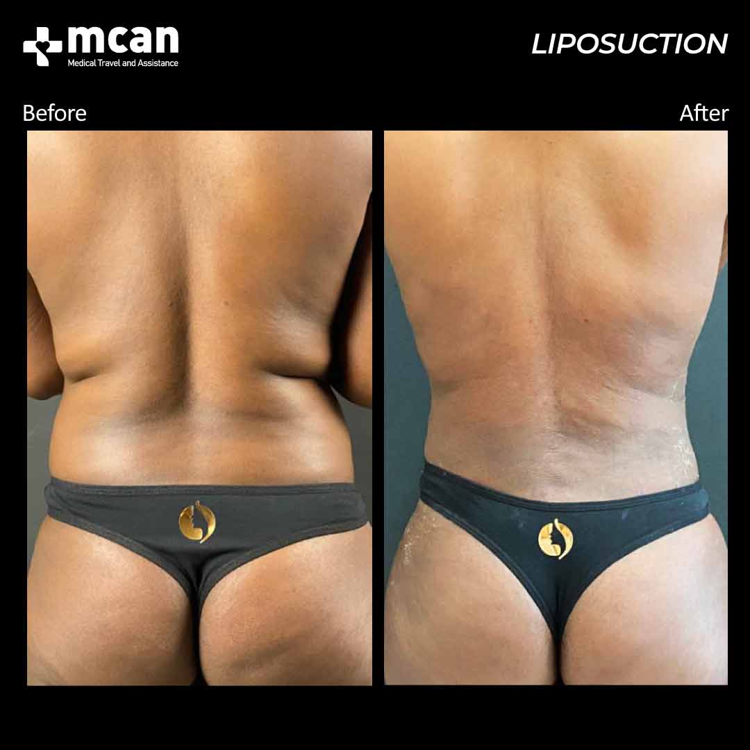 liposuction in turkey before after 200501