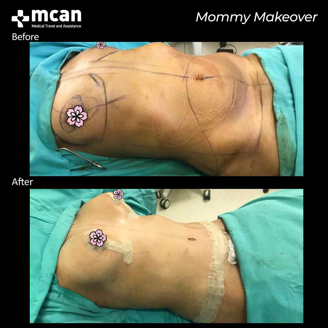 mommy makeover turkey before after 07052101
