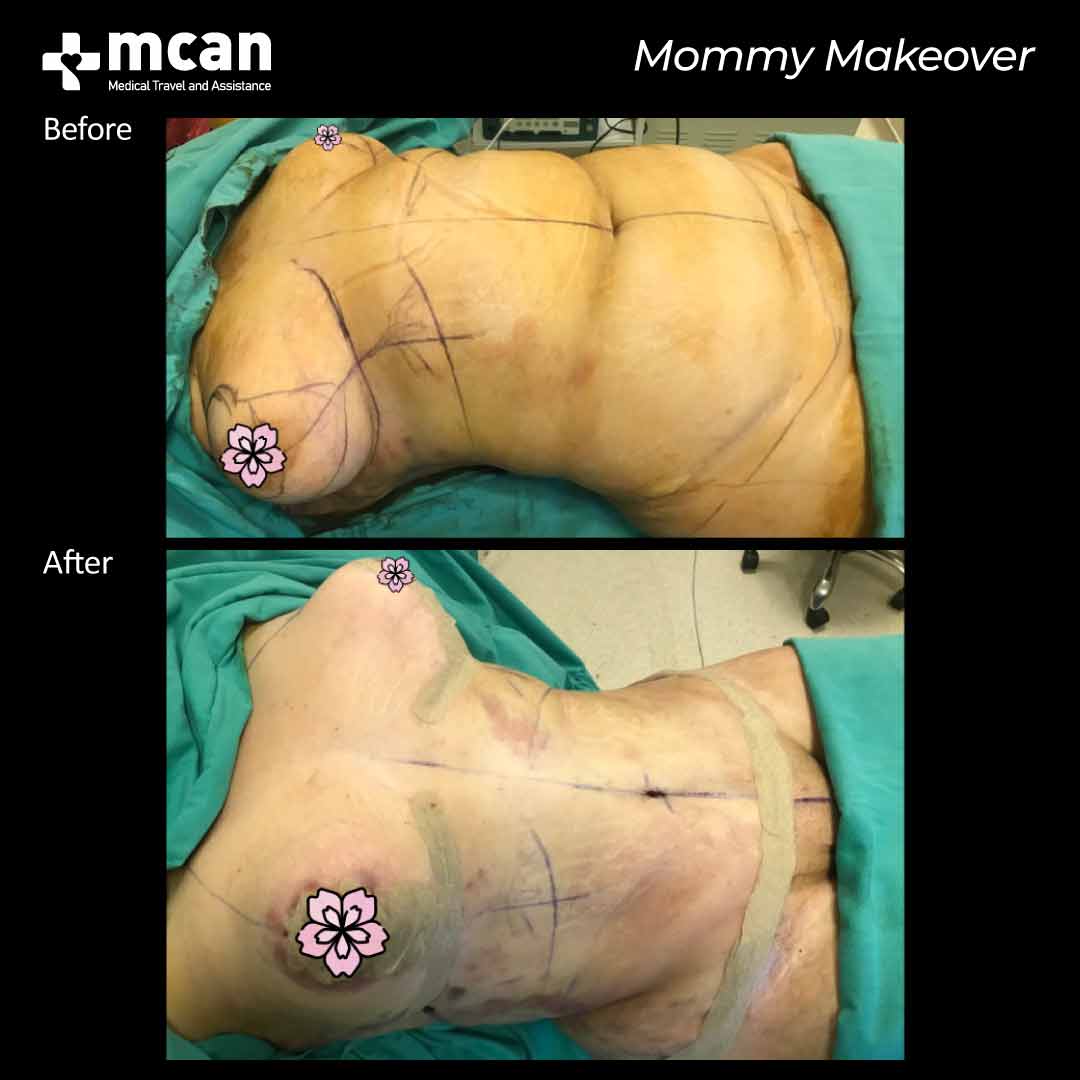 mommy makeover turkey before after 07052103