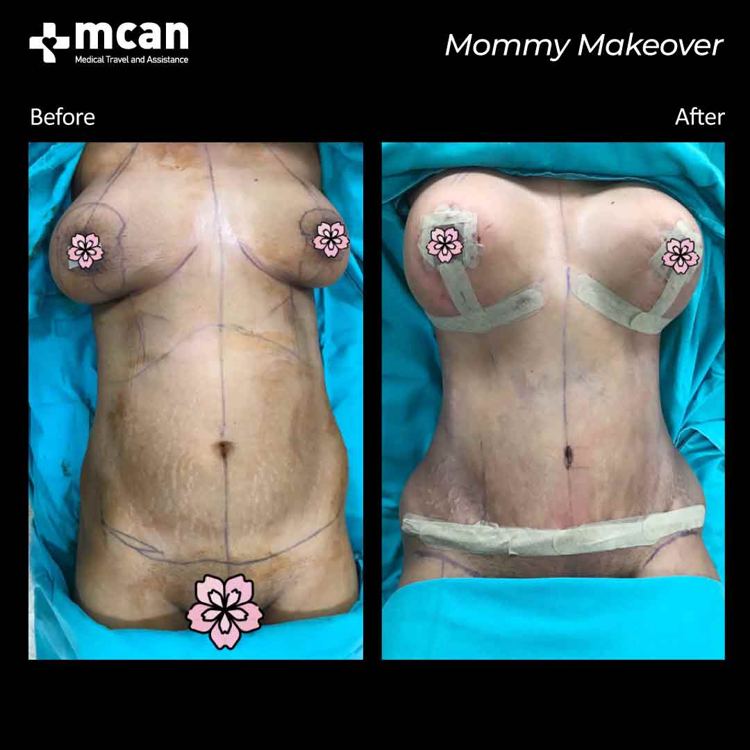 mommy makeover turkey before after 07052104