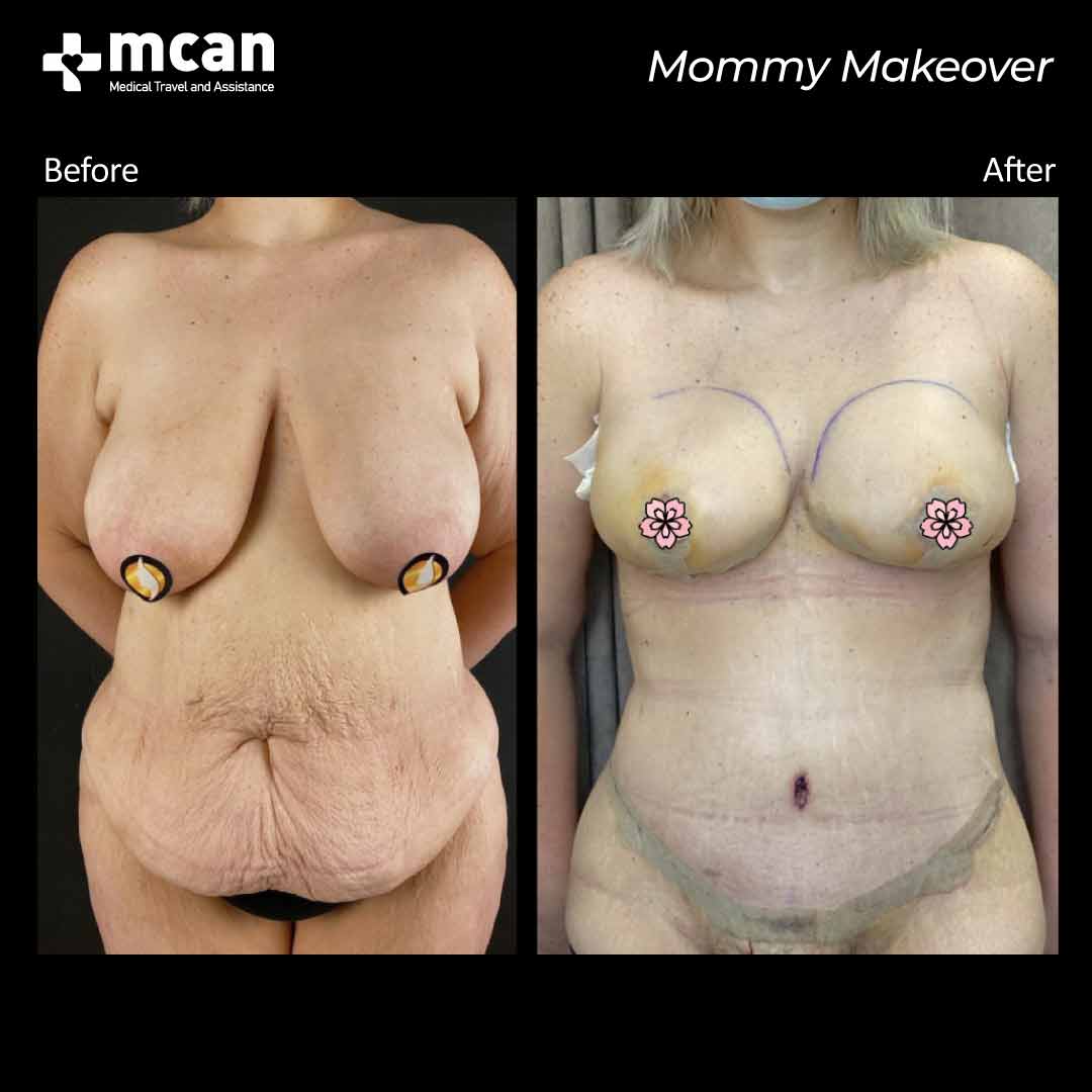 mommy makeover turkey before after 07052105