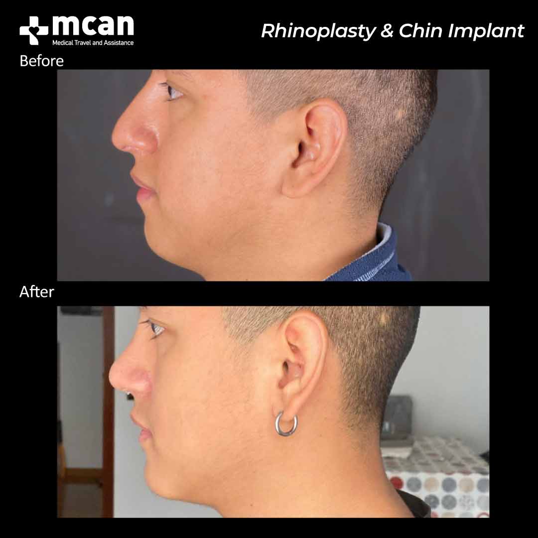 rhinoplasty and chin implant before after 200501