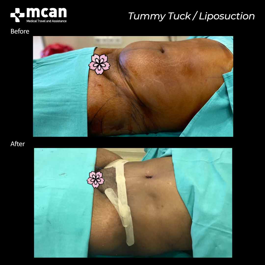 tummy tuck and liposuction turkey before after 07052101
